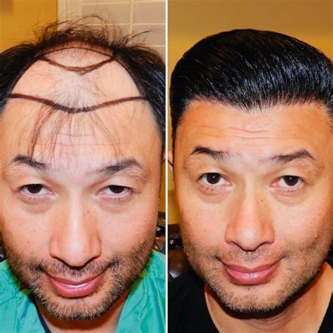 best hair restoration clinic st louis|About Us – Moore Hair Transplant Clinic St Louis.
